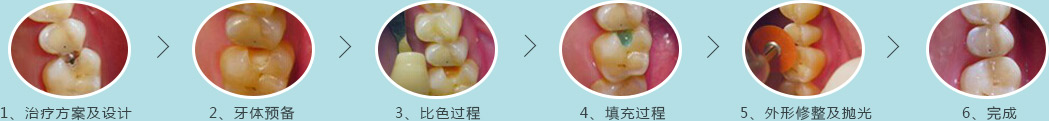 美国3M树脂补牙技术